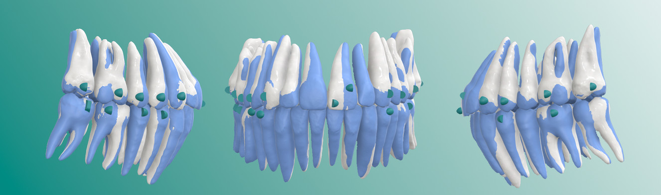 NEXO aligner real cases