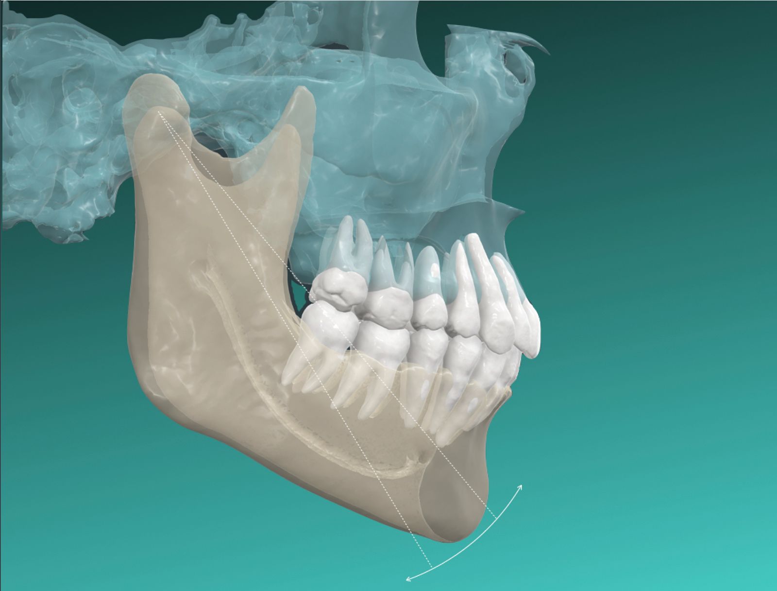 3D rendering of the skull, jaw and temporomandibular joints showing the path of mandibular movement